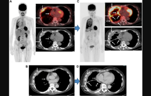 Comparison of FDG-PET/CT and CT for Treatment Evaluation of Patients With Unresectable Malignant Pleural Mesothelioma