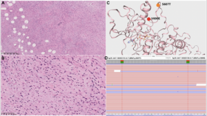 Response of BRAF-Mutated Spindle Cell Sarcoma to BRAF/MEK Inhibitors