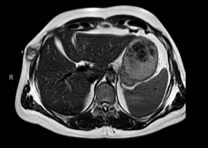 Complete Response to Encorafenib + Binimetinib in BRAF V600E-Mutant Tumor