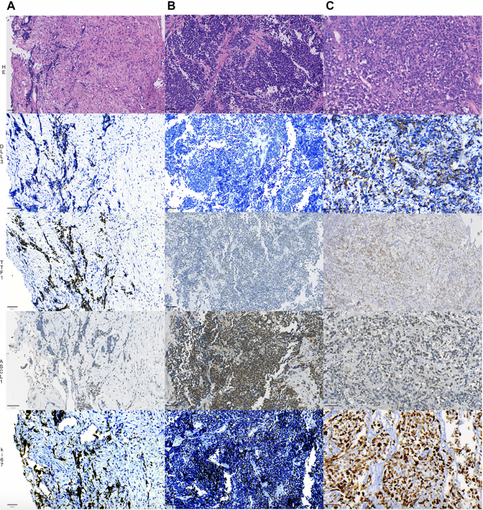 Figure 1: Representative slides of 3 different cases of SCLC (A–C), showing distinct morphology (top panel, HE sections) and expressions of DLL3 in the second row, TTF1 in the third row, ASCL1 expression in the fourth row and ki67 index in the fifth and final row. The first cases (1st column) shows a moderate expression of DLL3, strong positivity for TTF1, weak and focal positivity for ASCL1; the second case (second column) shows negative DLL3, negative TTF1, strong and diffuse nuclear expression for ASCL1, while the third case (3rd column) shows strong positivity for DLL3, TTF1 and ASCL1. All cases show a high ki-67 proliferative index. Bars = 50 µM (micrometers).