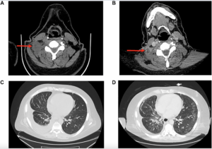 New Genetic Mutation Linked to Drug Resistance in Non-Small Cell Lung Cancer Patient